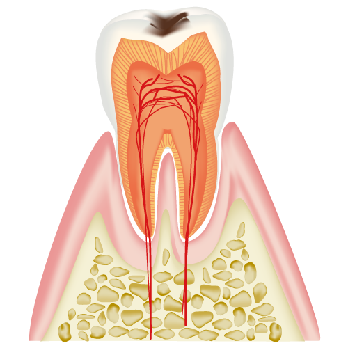 C1　エナメル質のむし歯