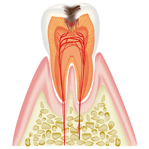 C2　象牙質のむし歯